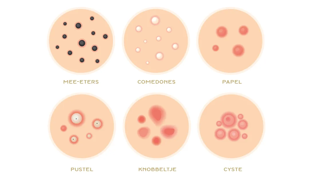 Verschillende soorten acne Verschillende soorten acne